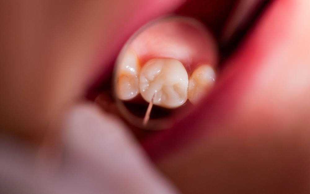 Nicht ganz billig: Eine Zirkon-Vollkeramikkrone ist ein Fall für die Zahnzusatzversicherung