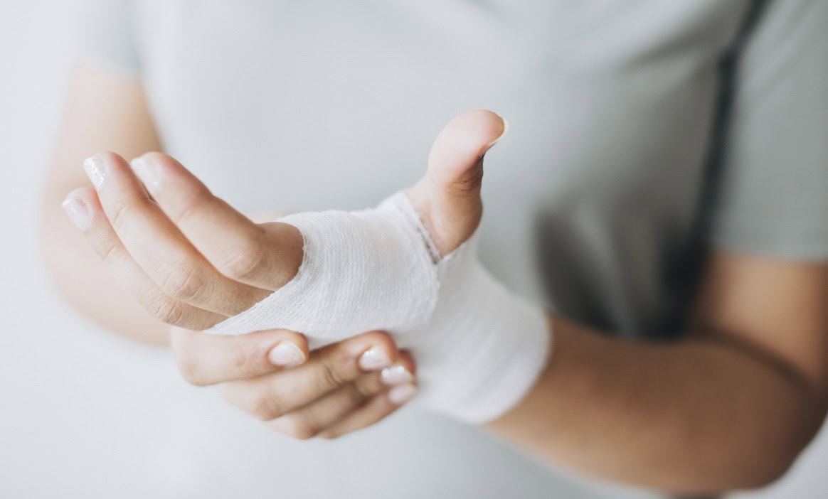 Frau hält ihre gebrochene Hand: Eine gebrochene Hand ist nicht zwangsläufig ein Zahlungsgrund für eine Reiserücktrittsversicherung.